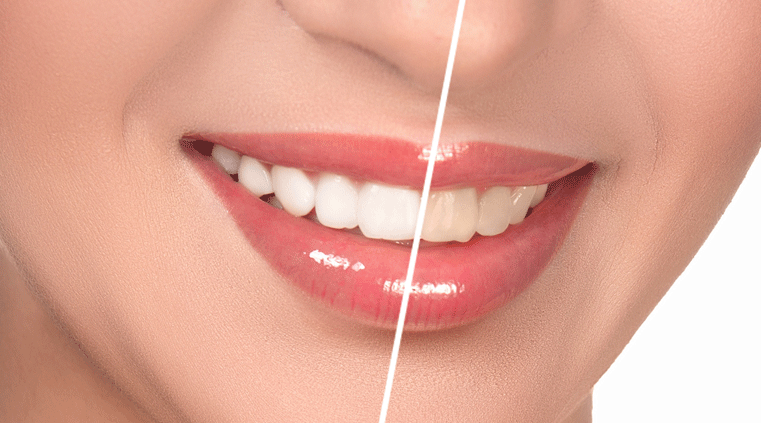 whitener teeth