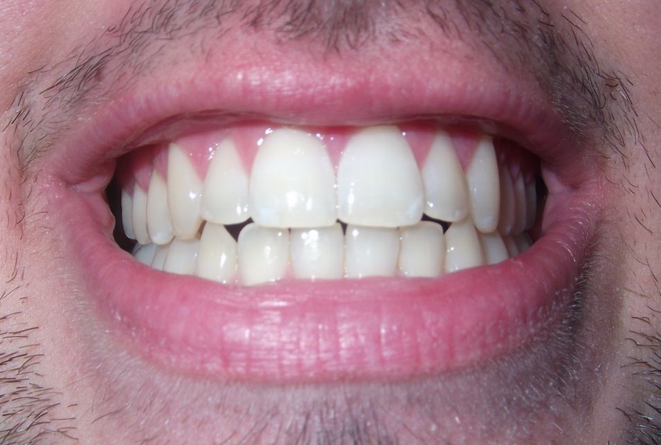 White Teeth